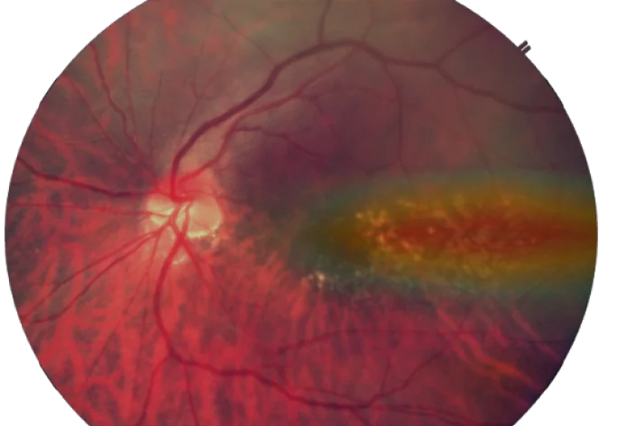 ARMD retina img1 mob