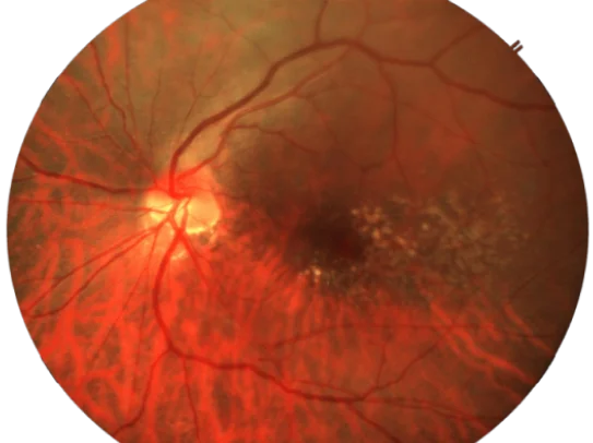 ARMD retina img2 desk