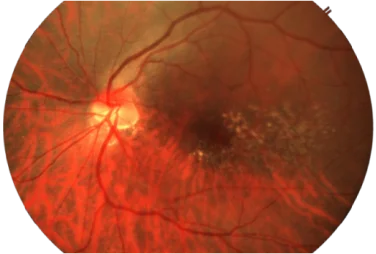 ARMD retina img2 mob