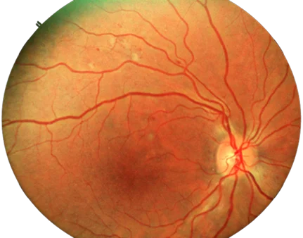 DR - Retinal Images -mob