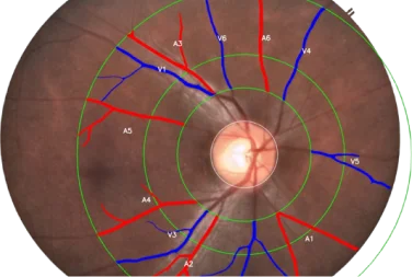 Retinal Images and CVD new mbl