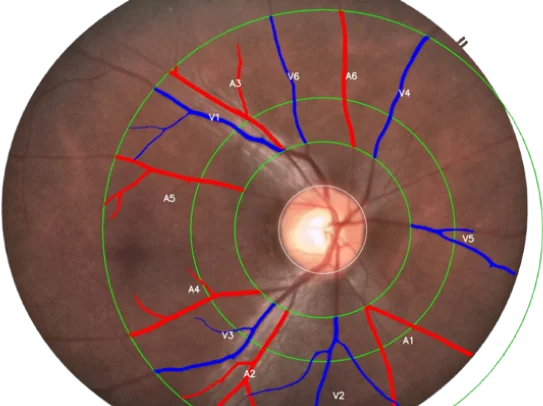 Retinal Images and CVD new