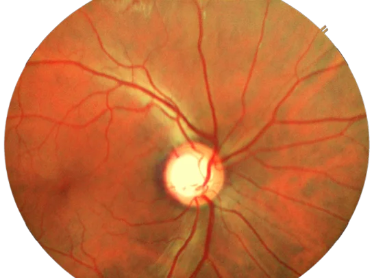 glucoma retina img2 desk