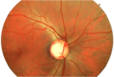 glucoma retina img2 mob