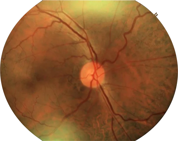hypertensive retia desktop