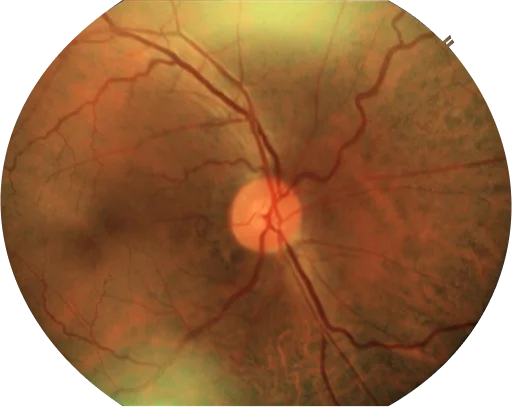 hypertensive retia mbl new