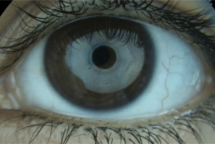 tmh eye img mob